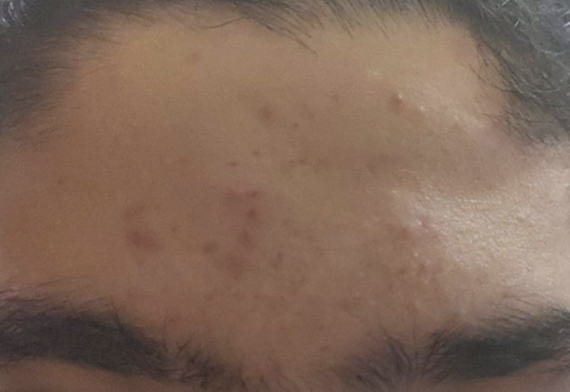 Acne Before